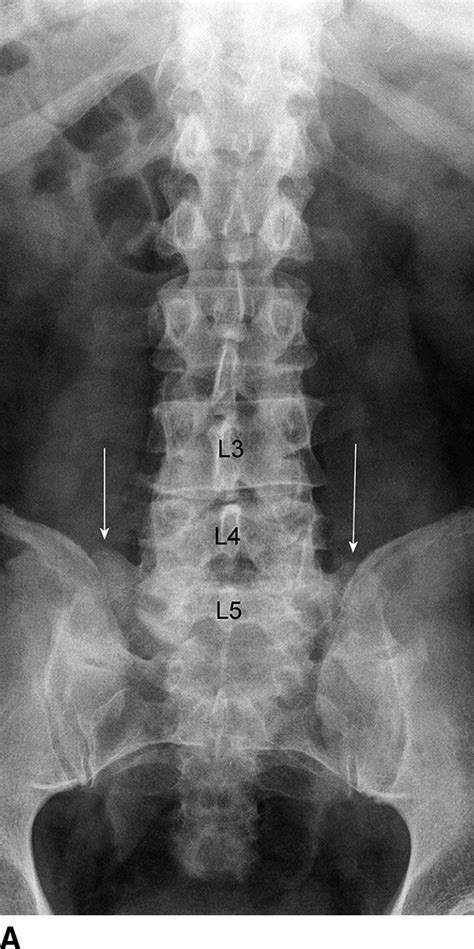 Sacral area (base of the spine). Degenerative Diseases of the Spine | Radiology Key
