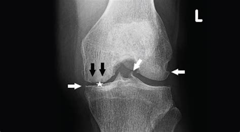 Racgp Imaging Of The Knee