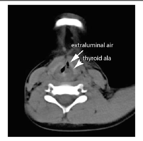 Figure 1 From Laryngeal Trauma In A 7 Year Old Child Semantic Scholar