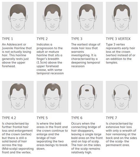 Types Of Hair Loss Essex Hair Clinic