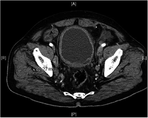 Abdominal Pelvic Computed Tomography Ct Scan Lymphadenopathy And