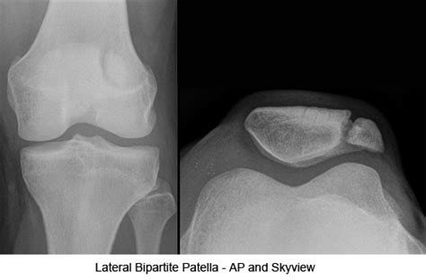 Patella Fracture Trauma Orthobullets