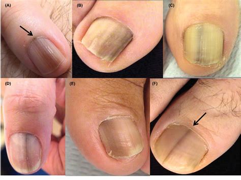 Ostia 30 Fatti Su Melanoma Nail Symptoms This Is More Common In People With Dark Skin But Can