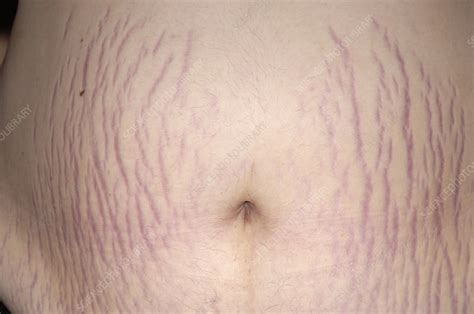 Stretch Marks Stock Image M8070872 Science Photo Library