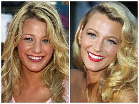 Celebrity Veneers Blake Lively Veneers Celebrities With Veneers Smile Makeover Lip Fillers