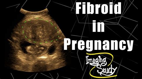 Pregnancy With Uterine Fibroid Ultrasound Case 76 Youtube