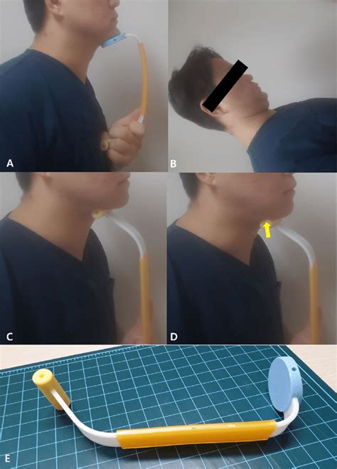 A Chin Tuck Against Resistance Ctar Exercise B Shaker Exercise