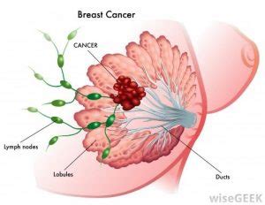 Although it is often a type of invasive ductal carcinoma, it differs from other types of breast cancer in its symptoms, outlook, and treatment. Top 10,Warning Signs,Breast Cancer,Symptoms