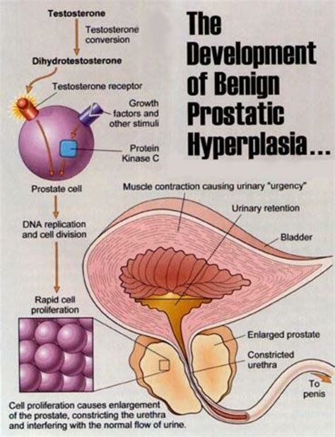 Beta Sitosterol Prostate Treatment For Benign Prostatic Hyperplasia BPH HealDove