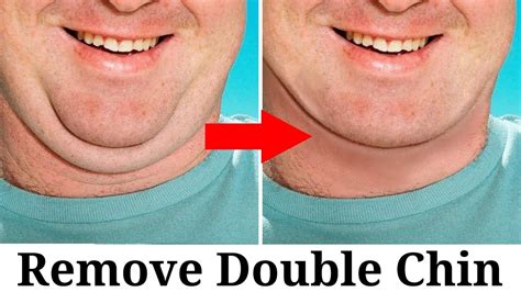 Remove Double Chin From Photo Elwoodroegner 99