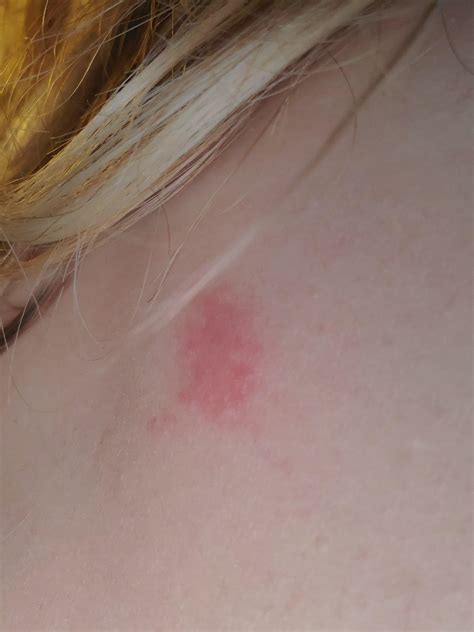 What Is This Itchy Rash That Appears Sometimes On Different Parts Of My