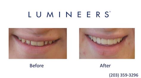 smile gallery before and after dental photos smile makeovers stamford ct