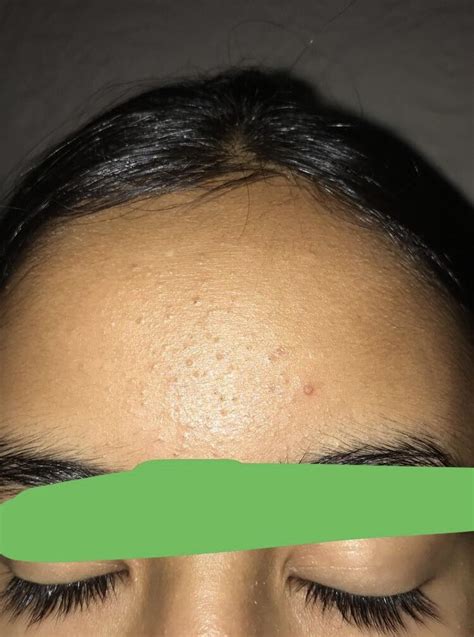 Tiny Bumps On Forehead General Acne Discussion