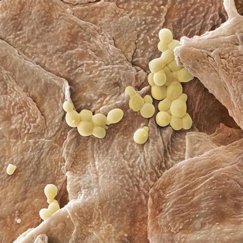 Yeast Fungus Skin Infection Sem Photograph By Power And Syred