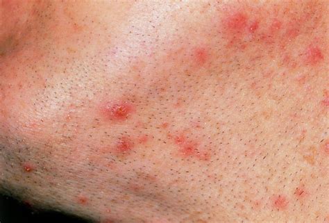 Close Up Sycosis Barbae Of Mans Beard Photograph By Science Photo Library