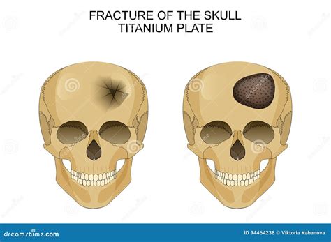 Traumatic Brain Injury Titanium Plate Stock Vector Illustration Of