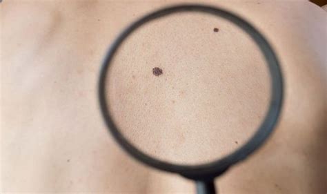 Melanoma is a type of cancer that usually begins in the skin. Skin cancer: Have you noticed this common first sign on ...