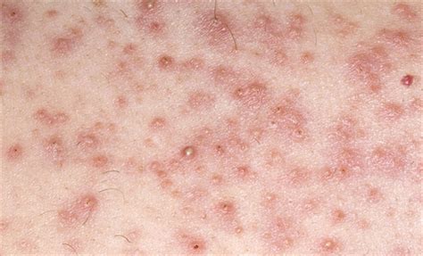 Cetuximab Induced Rash In A 54 Year Old With Scc Cancer Therapy Advisor