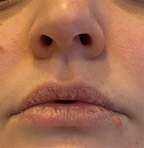 [skin Concerns] I Put On Aquaphor Several Times A Day And My Nose And Lips Continue To Stay