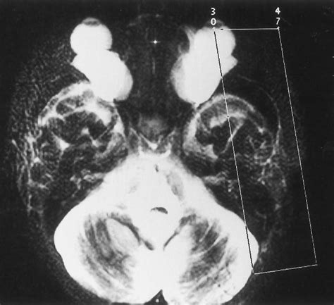 Axial Single Shot Rare Image Shows The Imaging Slab For Mr Sialography