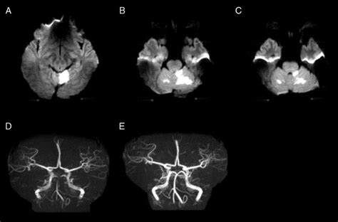 Bilateral Infarcts In The Territory Of The Superior Cerebellar Artery