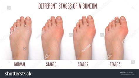 Different Stages Bunion Stock Photo Shutterstock