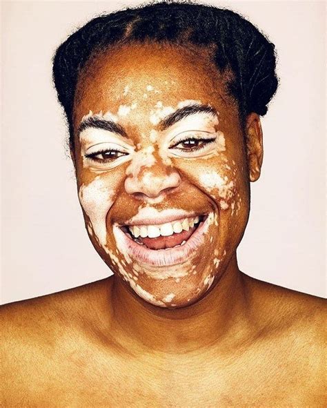 Girl With Vitiligo Vitiligo Vitiligo Treatment Dark Skin Women