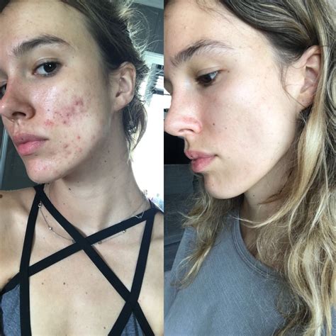 How I Cleared My Acne Monday Muse