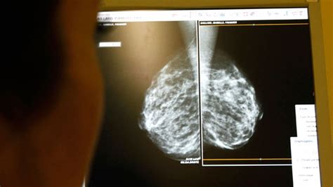 Most Breast Cancer Patients Who Have Double Mastectomy Don T Need It Fox News