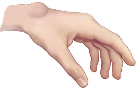 Ganglion Cyst On Dorsal Side Of Wrist Ganglion Cysts Information