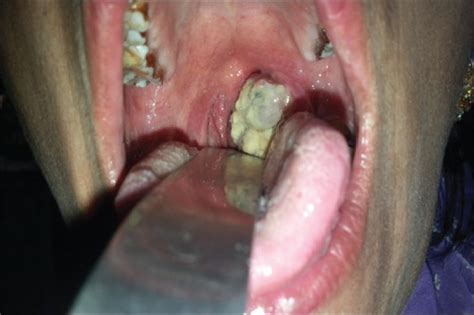 Figure 3 Tonsillar Carcinoma