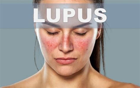 Lupus Síntomas ⊛ ¡prevención Y Tratamiento 2020