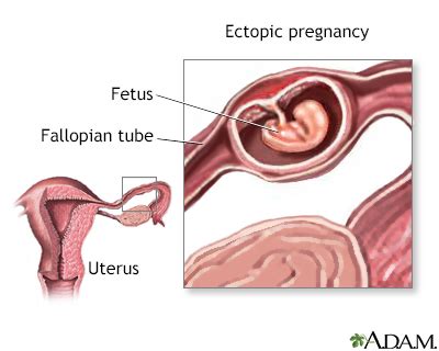 Ectopic Pregnancy Information Mount Sinai New York