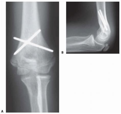 Supracondylar Humeral Osteotomy For Correction Of Cubitus Varus