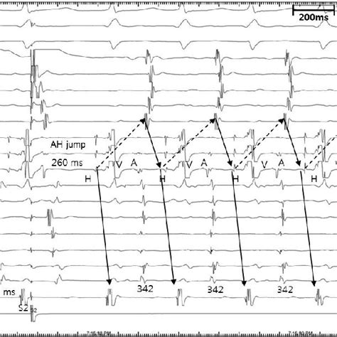 Initiation Of Atypical Atrioventricular Nodal Reentrant Tachycardia Download Scientific Diagram