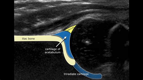 Congenital Hipdysplasia Ultrasound Anatomy Youtube