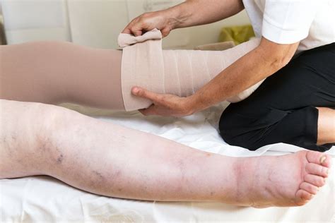 Lymphedema What It Is How To Identify It And Treatment