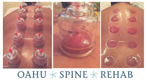 Cupping Therapy At Osr Oahu Spine Rehab