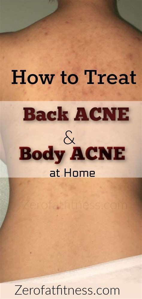 How To Get Rid Of Back Acne Overnight At Home 9 Natural Remedies For