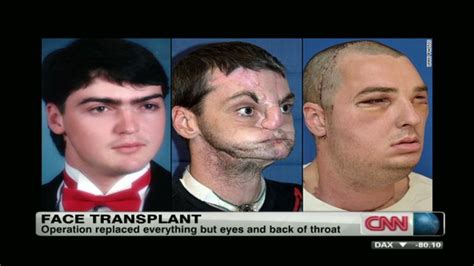 reaction to what doctors call the most extensive face transplant ever cnn