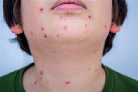 Acne On A Males Shoulder Stock Photos Pictures And Royalty Free Images