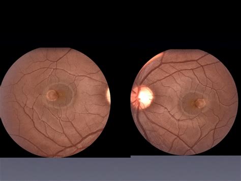 Best Disease Retina Image Bank