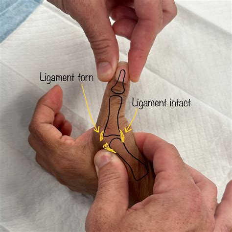 Thumb Ulnar Collateral Ligament Ucl Repair Dr Oscar Brumby Rendell Orthopaedics
