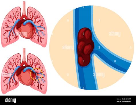 Human Anatomy Pulmonary Embolism Illustration Stock Vector Image Art