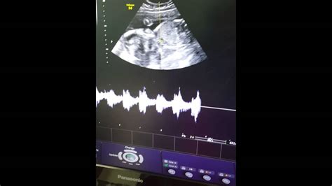 Baby Heart Beat Sound In Womb Ultrasound Scanning Weeks Kaurwaki Youtube