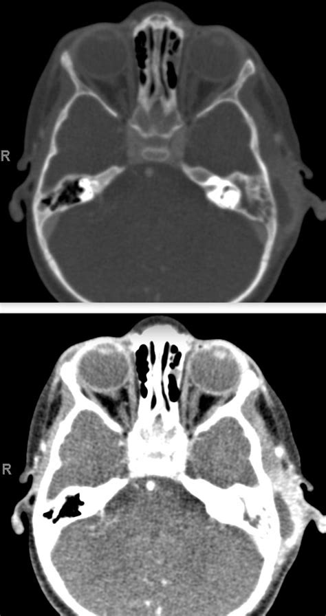 What Are The Complications Of Mastoiditis Pediatric Case And