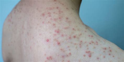 Folliculitis Causes And Treatment Options