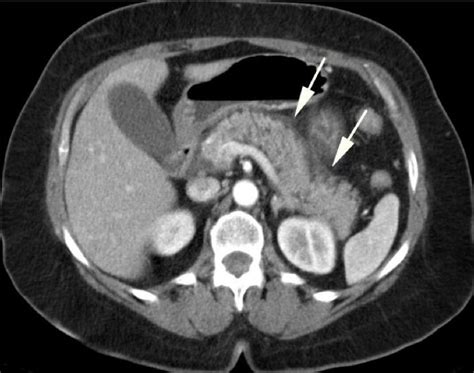 Cureus Acute Interstitial Pancreatitis With A Normal Lipase Level In