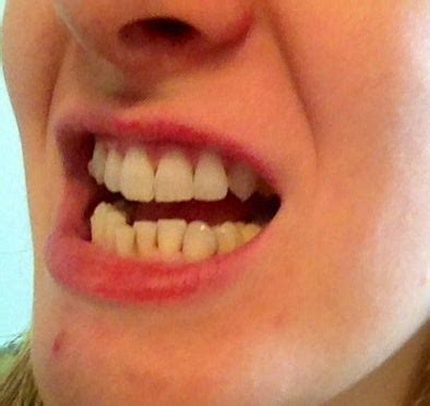 There are some cases for others when the how long does it take to correct an overbite with braces? Invisalign with Elastics for Crowding, Midline Correction ...