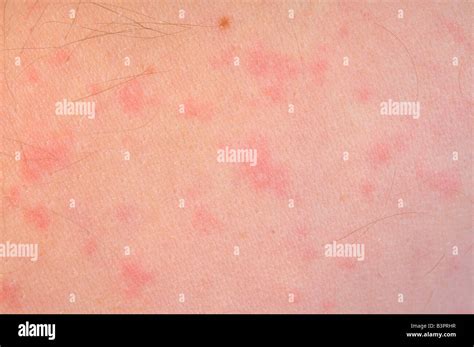 Skin Reaction High Resolution Stock Photography And Images Alamy